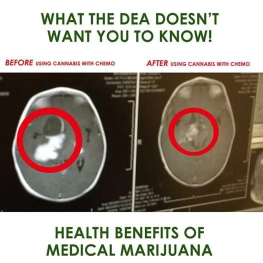 Cannabis shrinks brain tumor